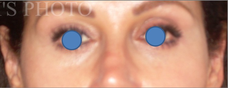Blepharoplasty before and after - after