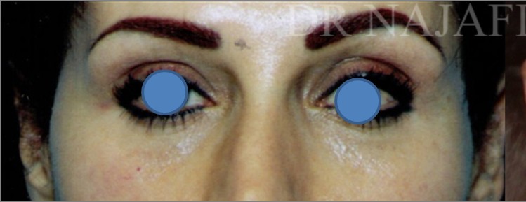 Blepharoplasty before and after - before