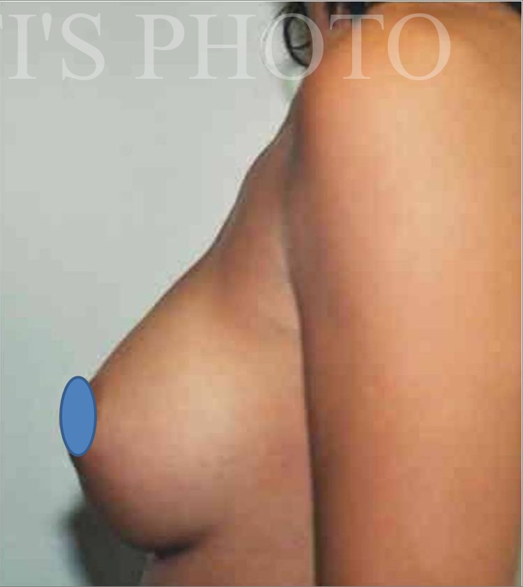 Breast Augmentation before and after - after