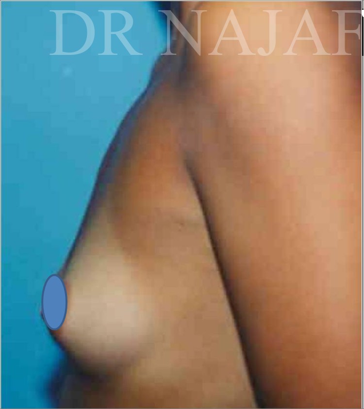 Breast Augmentation before and after - before