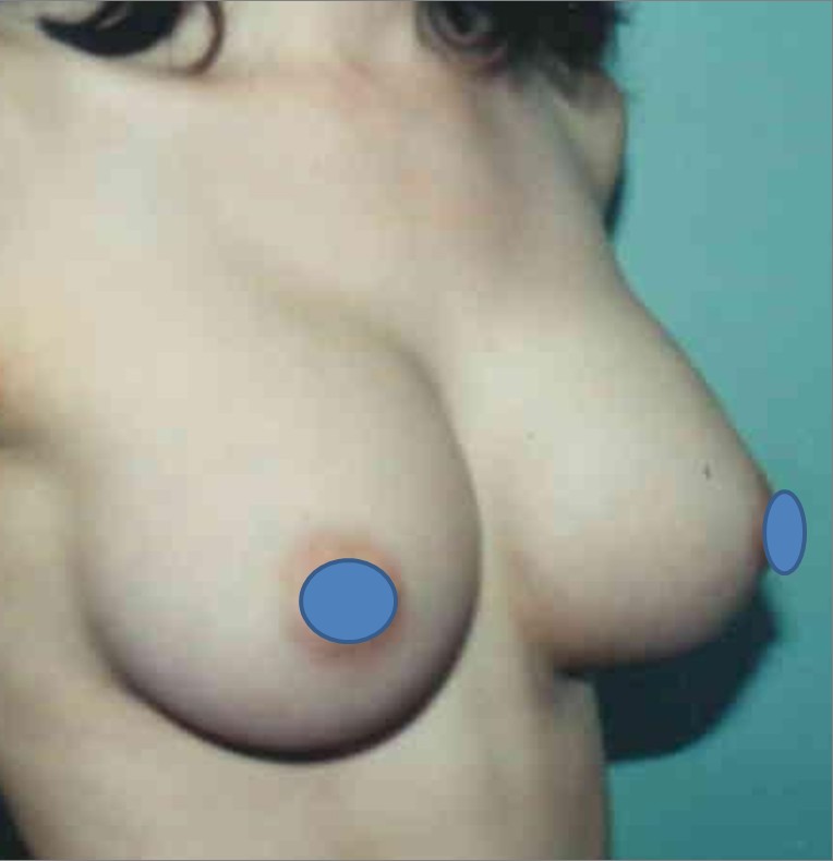 Breast Augmentation before and after - after