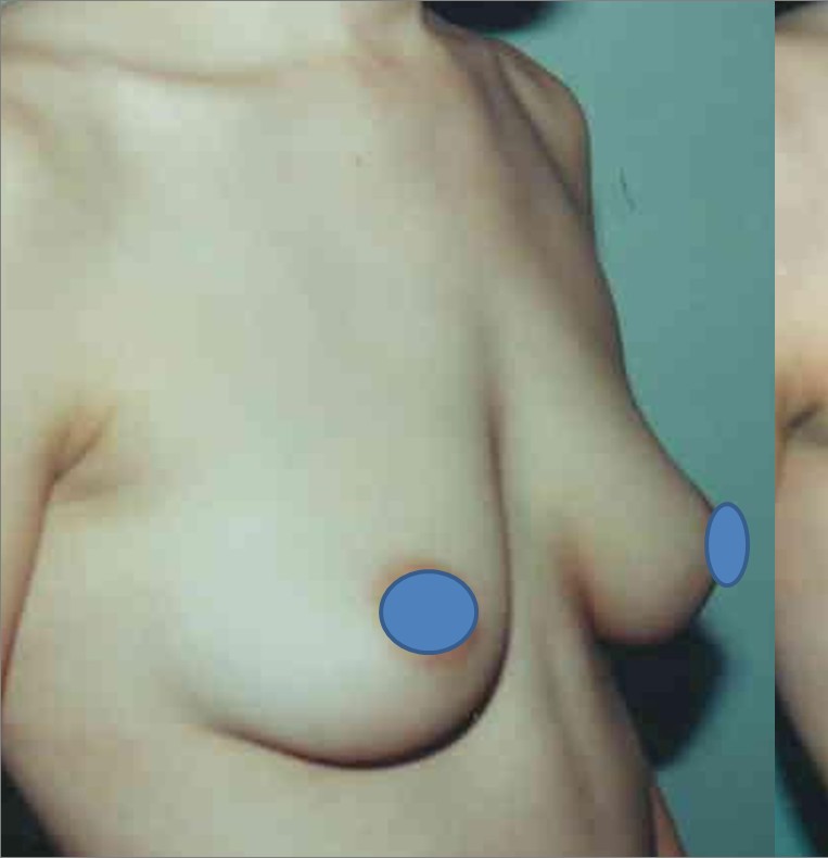 Breast Augmentation before and after - before