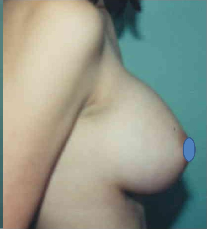 Breast Augmentation before and after - after