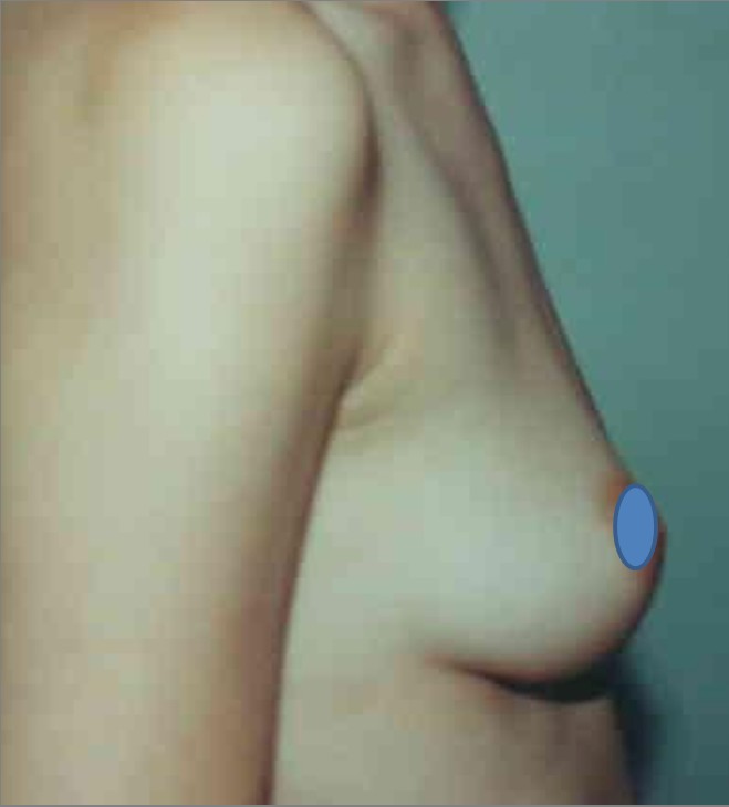 Breast Augmentation before and after - before