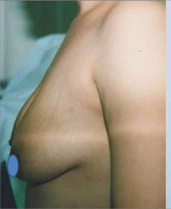 Breast Augmentation before and after - before