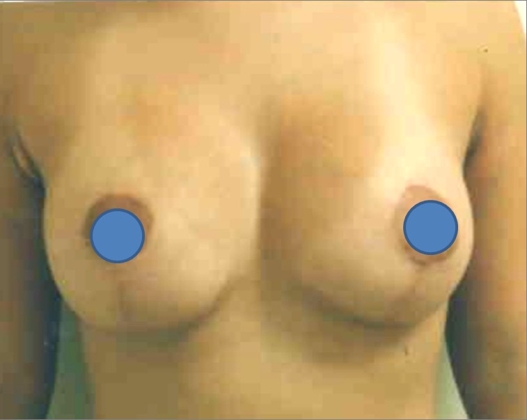 Breast Augmentation before and after - after