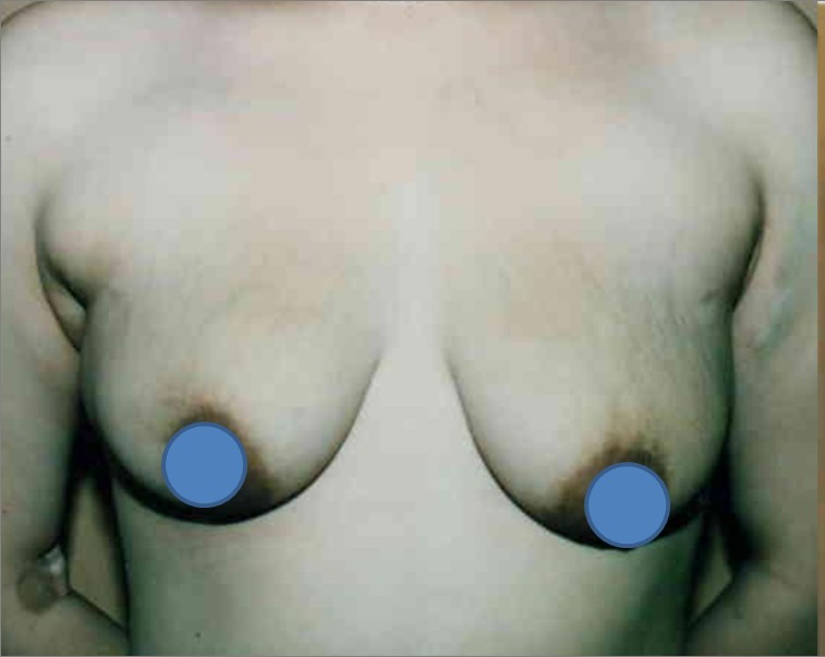 Breast Augmentation before and after - before