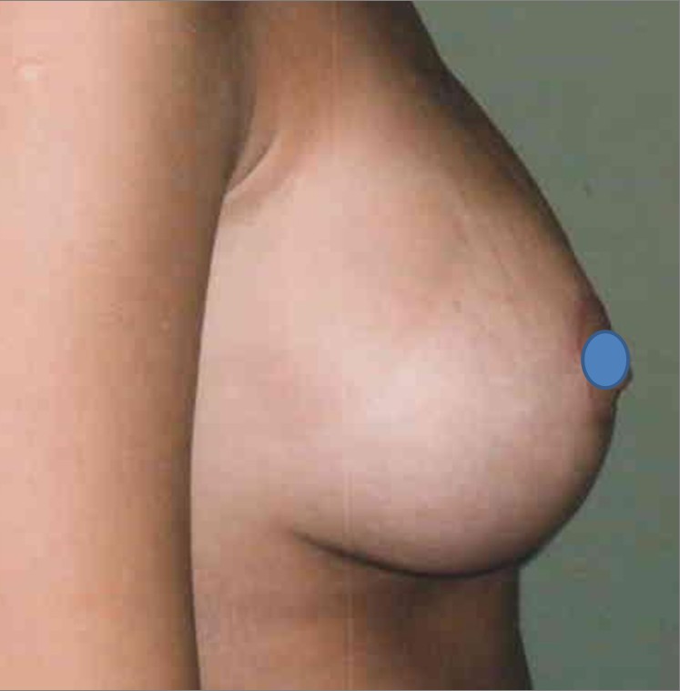 Breast Augmentation before and after - after
