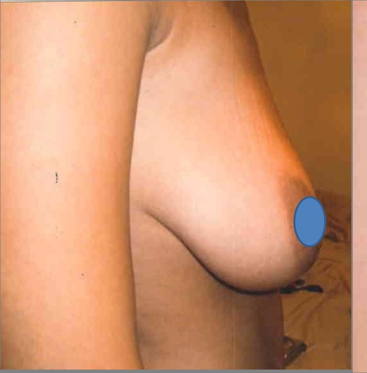 Breast Augmentation before and after - before