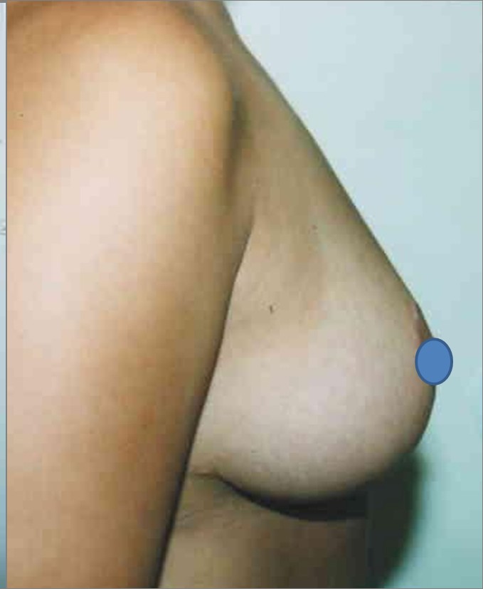 Breast Augmentation before and after - after