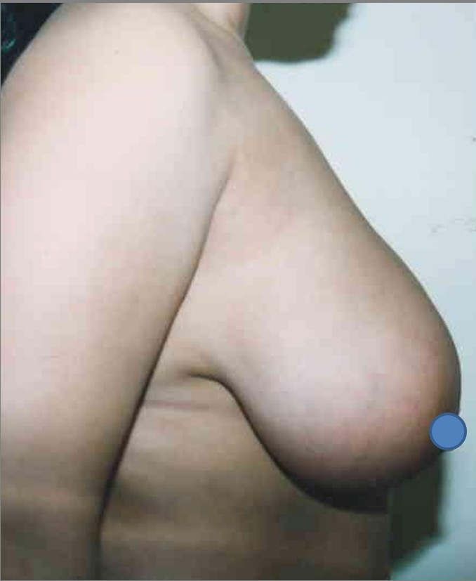 Breast Augmentation before and after - before