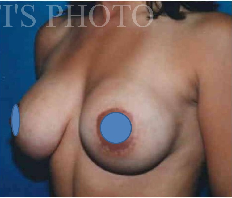 Breast Augmentation before and after - after