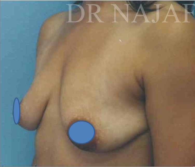 Breast Augmentation before and after - before