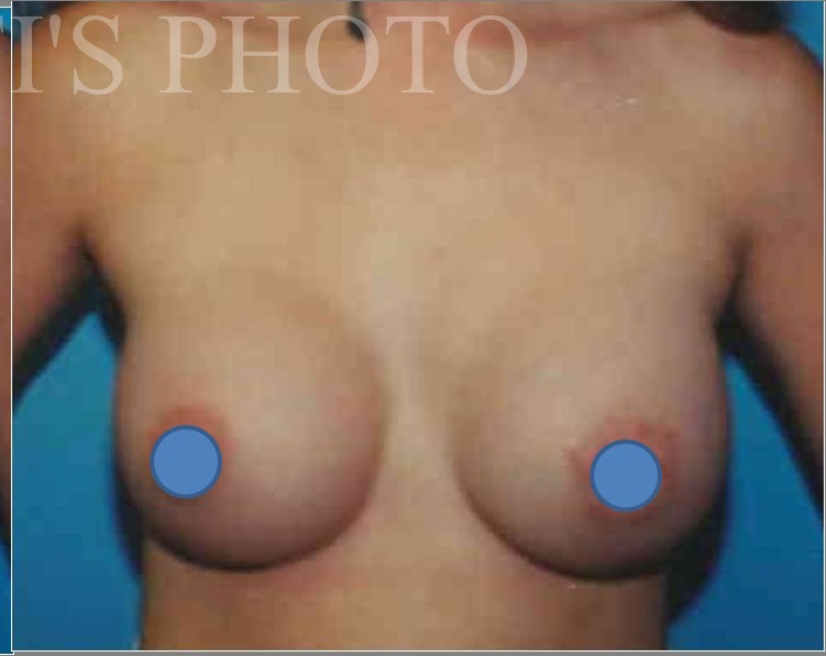Breast Augmentation before and after - after