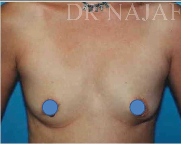 Breast Augmentation before and after - before
