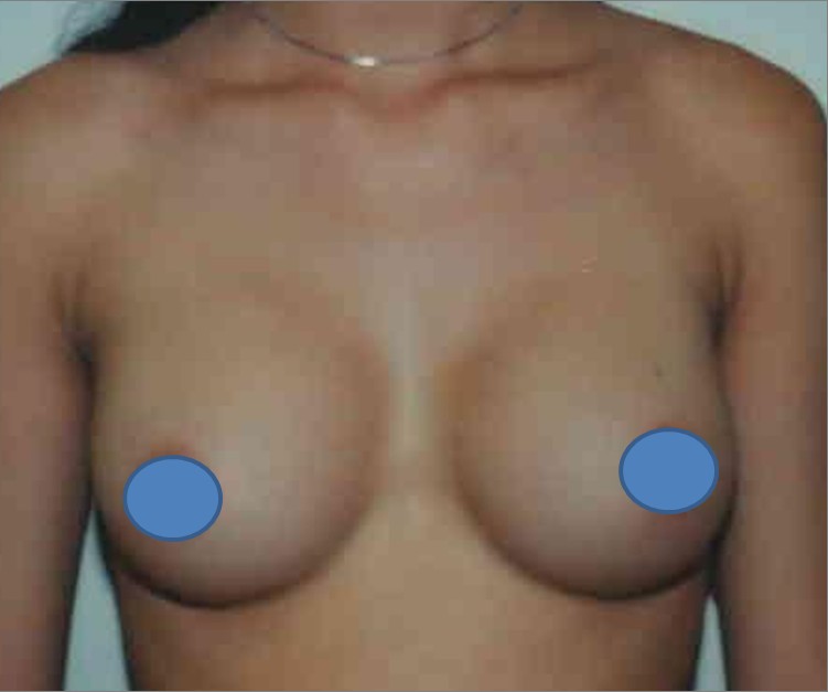 Breast Augmentation before and after - after