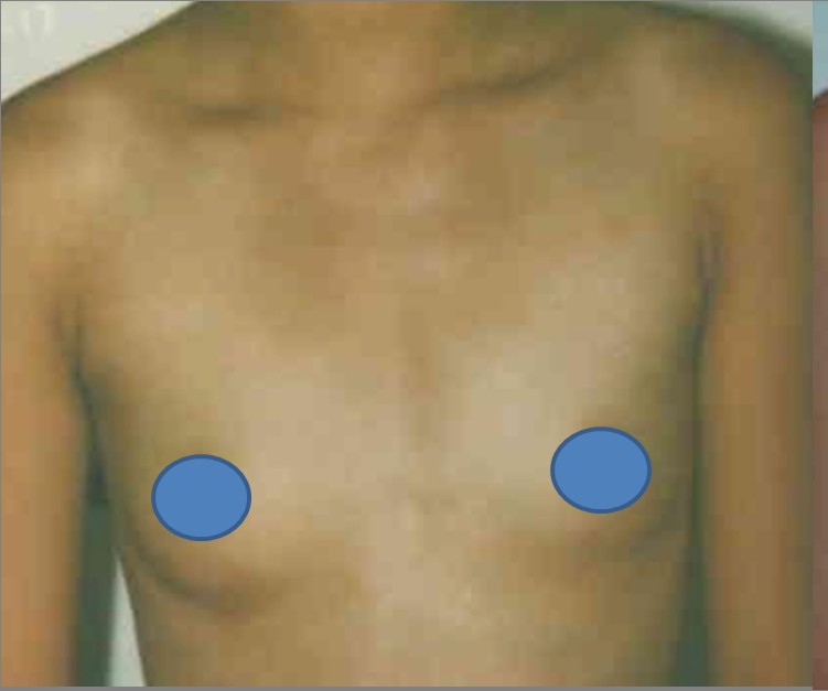 Breast Augmentation before and after - before