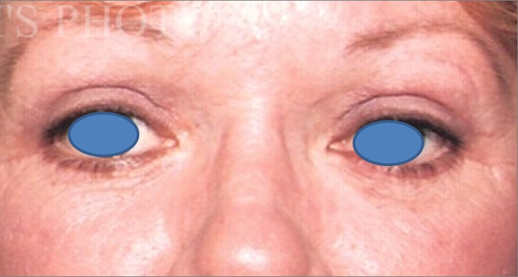 Blepharoplasty before and after - after