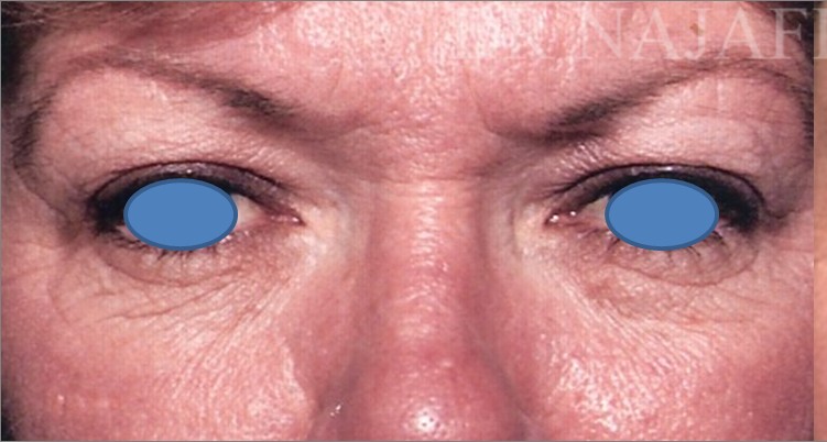 Blepharoplasty before and after - before