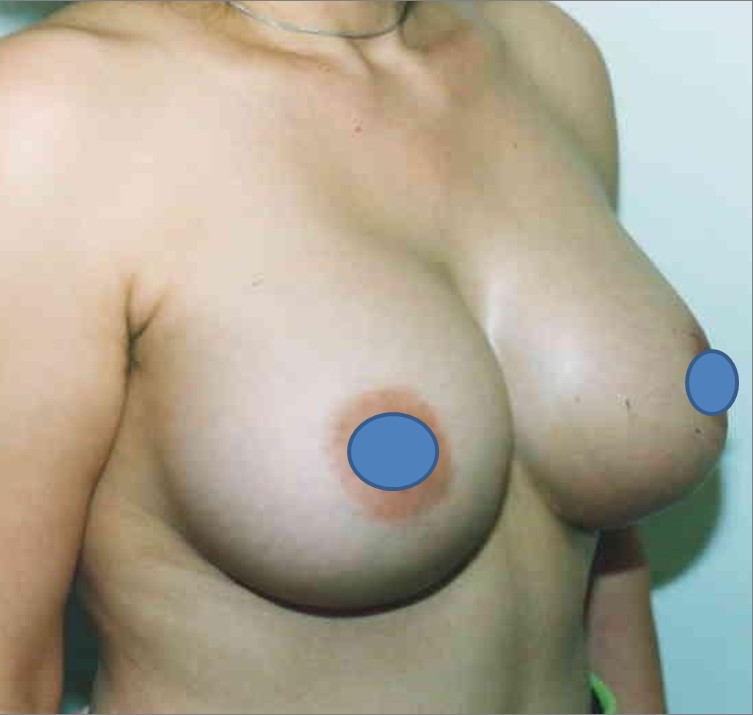 Breast Augmentation before and after - after