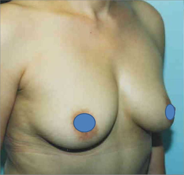 Breast Augmentation before and after - before