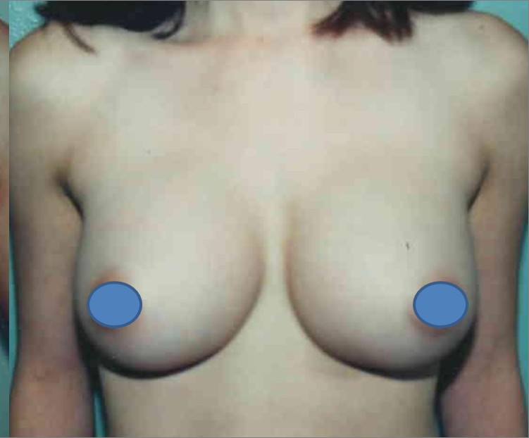 Breast Augmentation before and after - after
