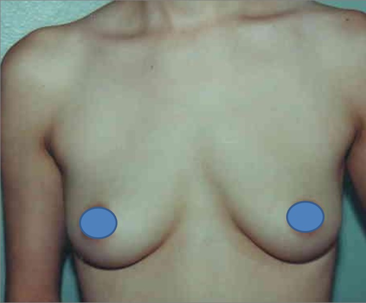 Breast Augmentation before and after - before