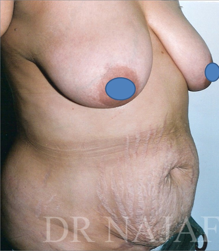 Breast Augmentation before and after - before