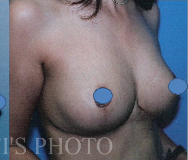 Breast Augmentation before and after - after