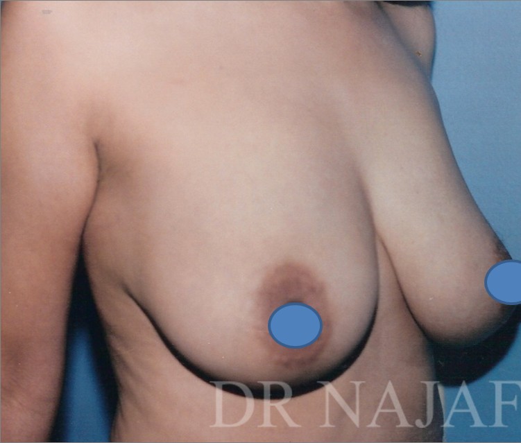 Breast Augmentation before and after - before