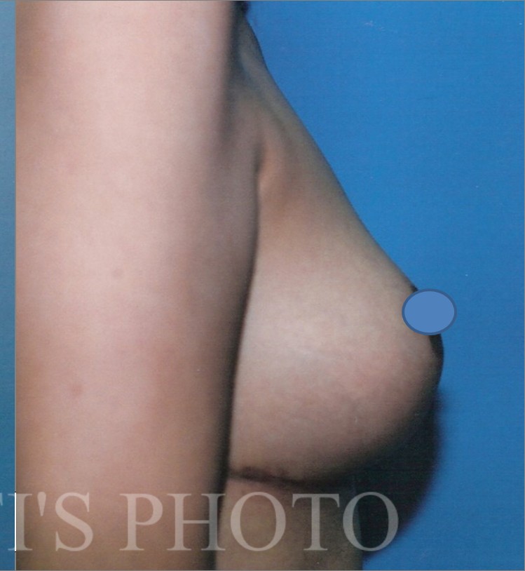 Breast Augmentation before and after - after