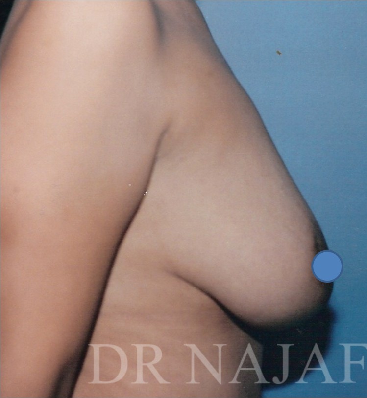 Breast Augmentation before and after - before