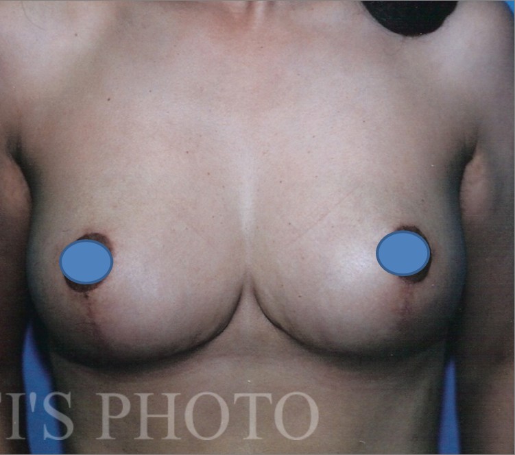 Breast Augmentation before and after - after