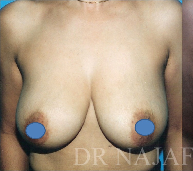 Breast Augmentation before and after - before