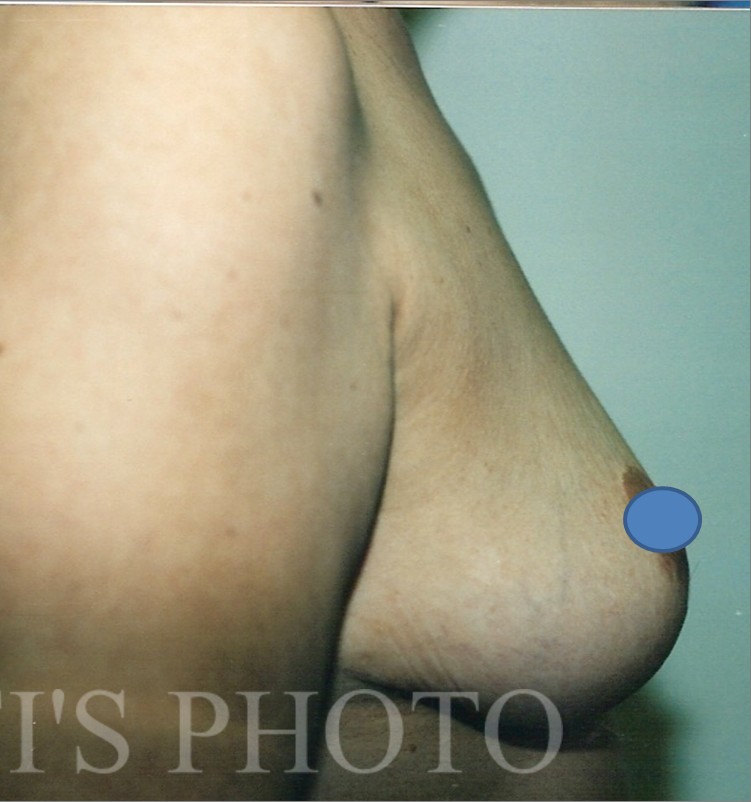 Breast Augmentation before and after - after