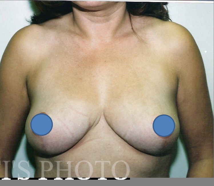 Breast Augmentation before and after - after