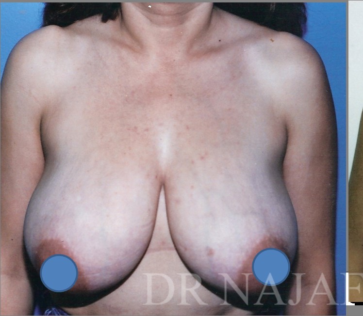 Breast Augmentation before and after - before