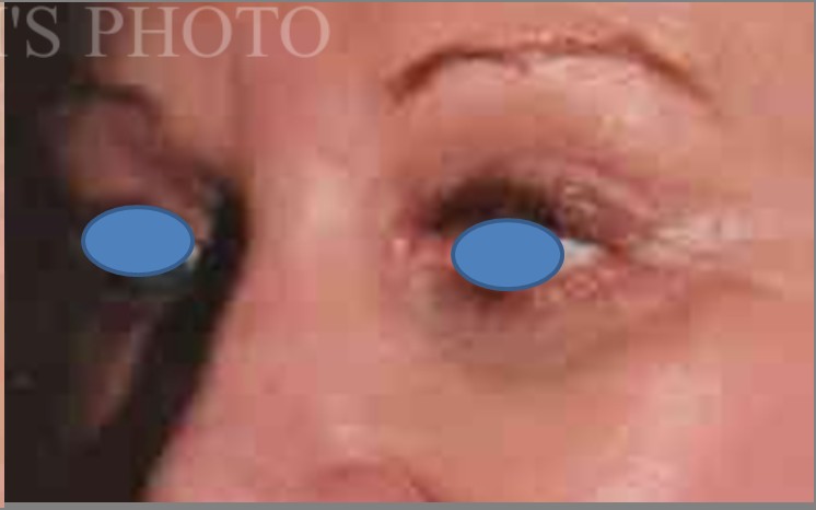 Blepharoplasty before and after - after