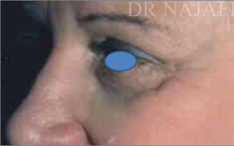Blepharoplasty before and after - before