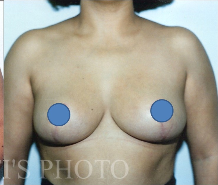 Breast Augmentation before and after - after