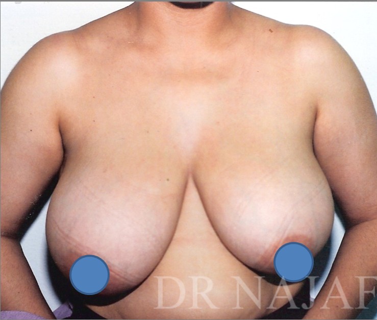 Breast Augmentation before and after - before