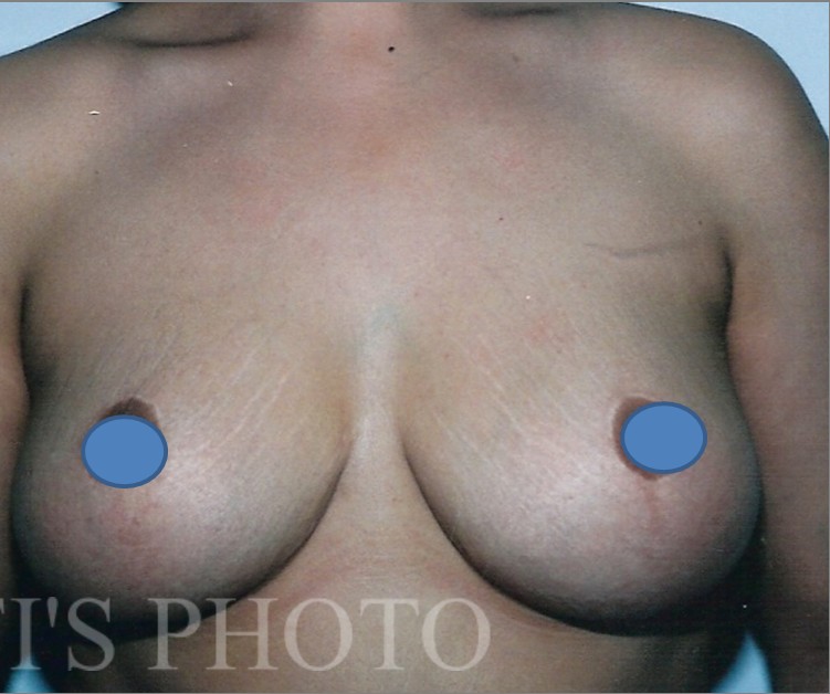 Breast Augmentation before and after - after