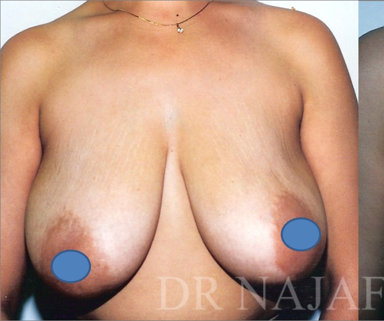 Breast Augmentation before and after - before