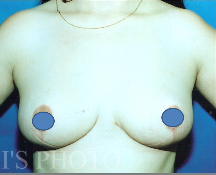 Breast Augmentation before and after - after