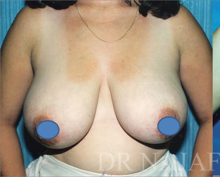 Breast Augmentation before and after - before