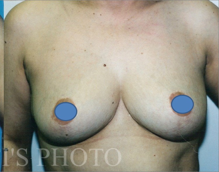 Breast Augmentation before and after - after