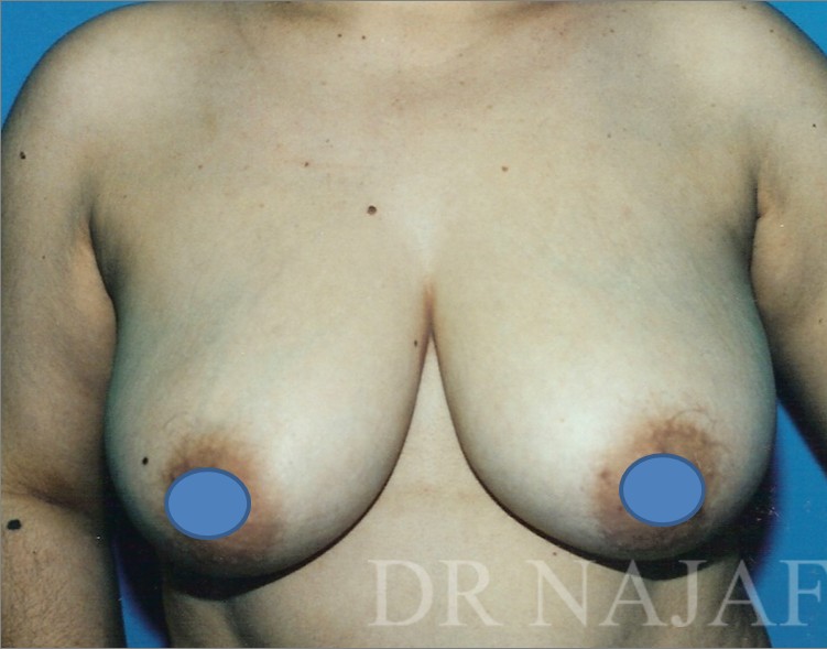 Breast Augmentation before and after - before