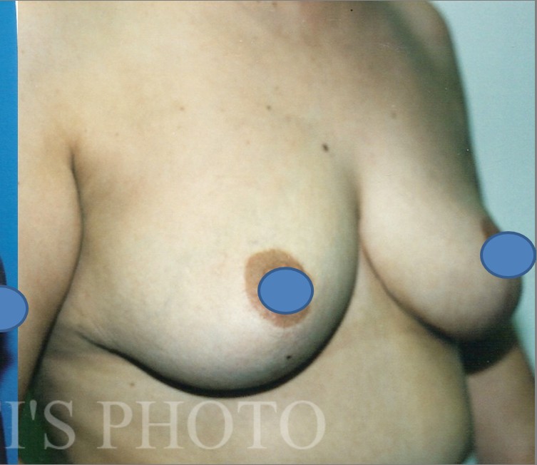 Breast Augmentation before and after - after