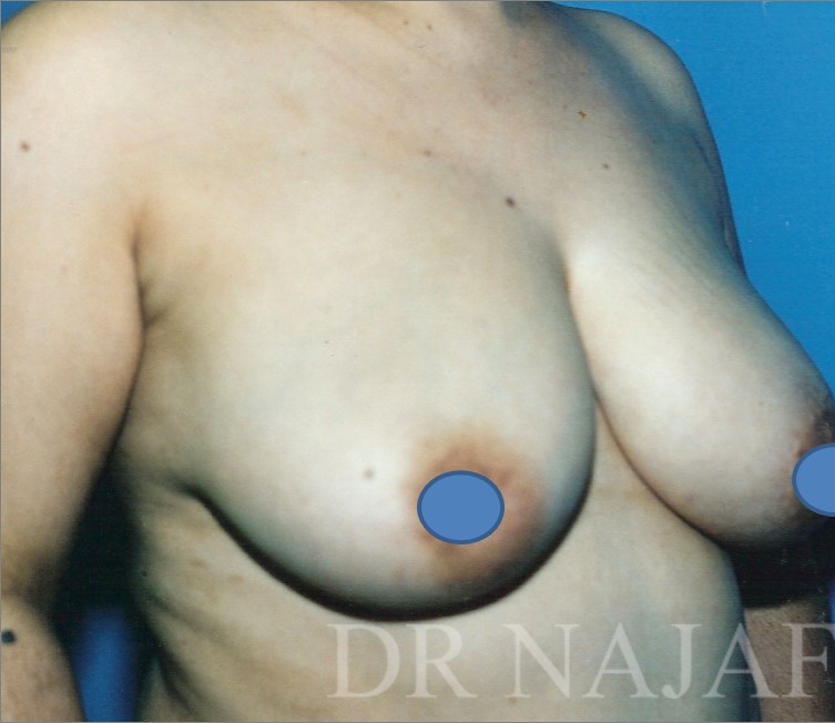 Breast Augmentation before and after - before