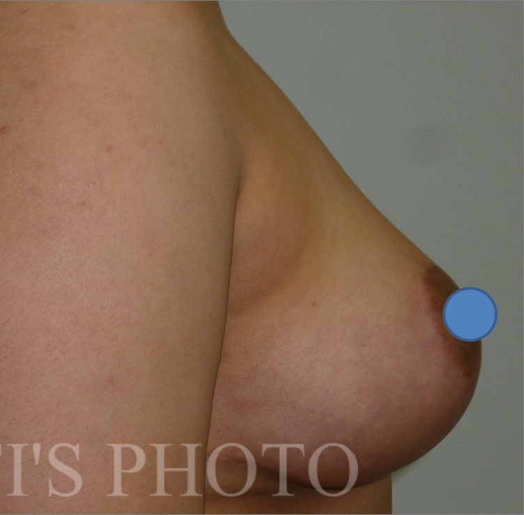 Breast Augmentation before and after - after